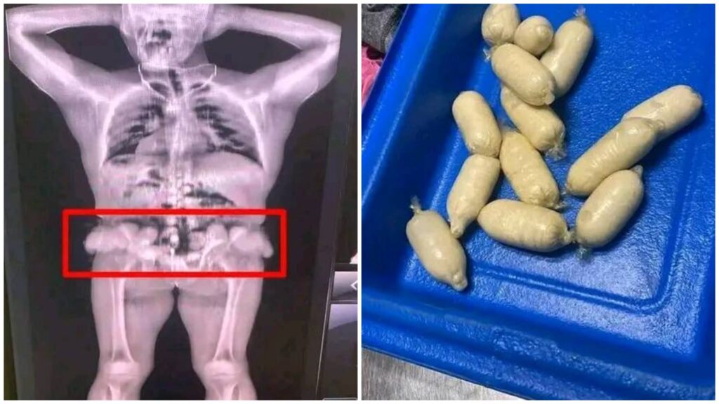 Radiografía con paquetes sospechosos y objetos en bandeja.