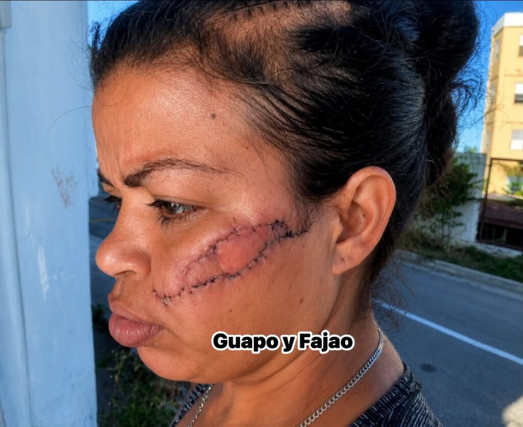 Mujer con una herida con puntos en la mejilla izquierda.