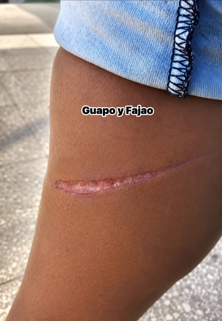 Primer plano de una cicatriz alargada en la piel.